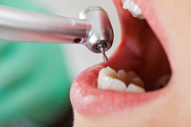 Best Emergency Dental Care for Broken or Chipped Teeth in Moundsville, WV